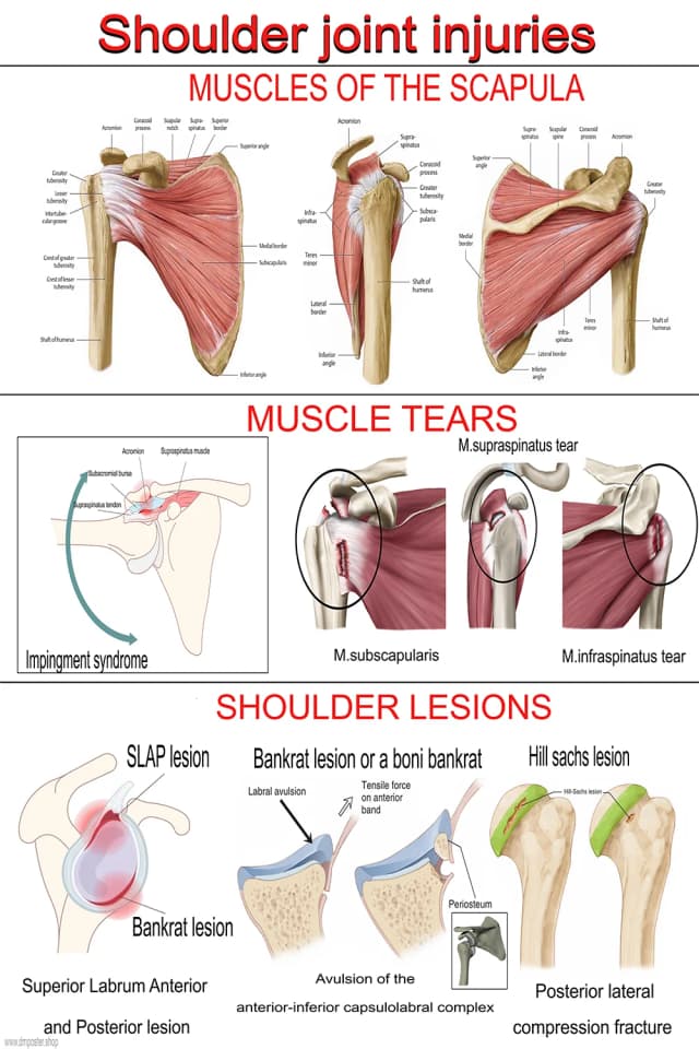 Shoulder Anatomy and Injury Poster