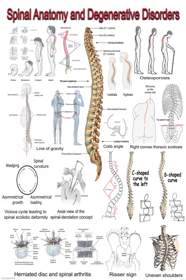 Spine Degeneration and Scoliosis Poster