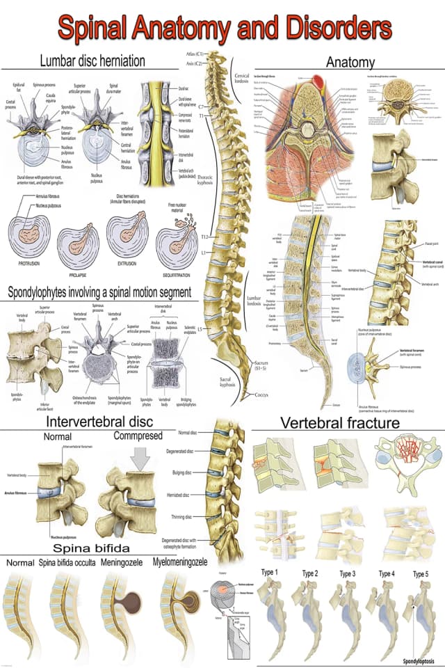 Spinal Disorders Anatomy Poster