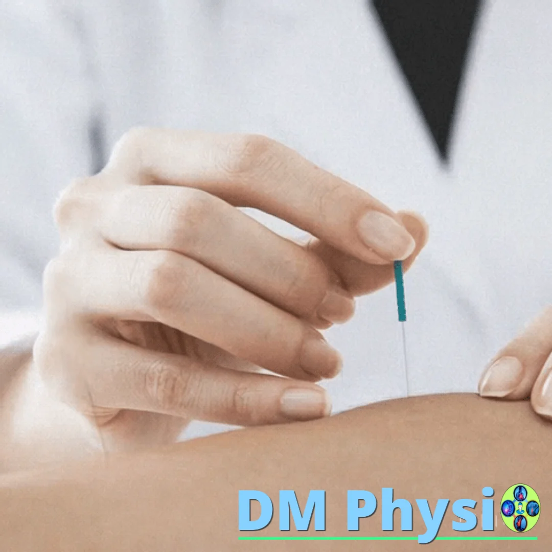 Терапия със сухи игли