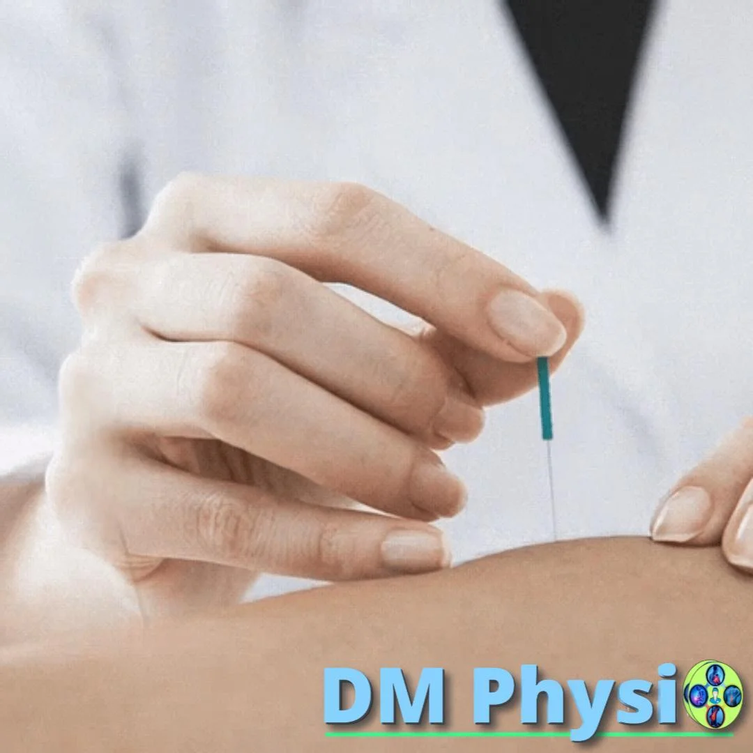 Терапия със сухи игли