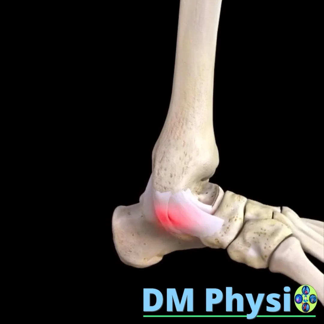 Еверзия на глезен