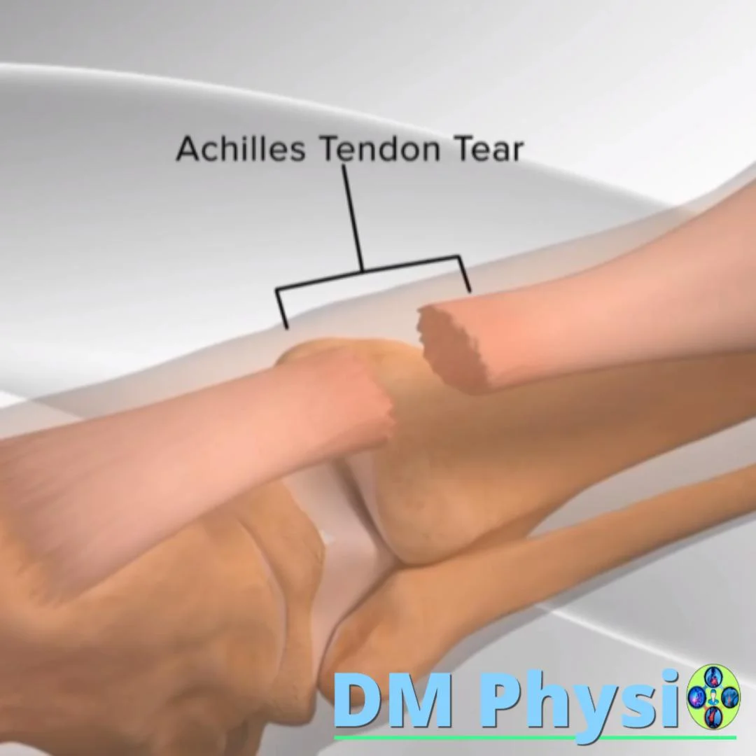 Ахилесово сухожилие - анатомия