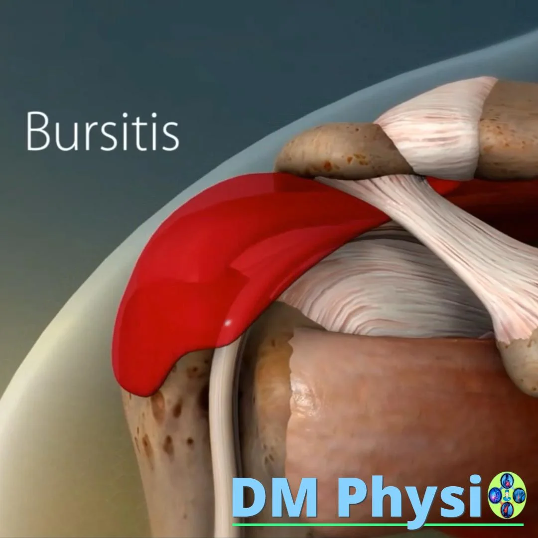 Бурсит на рамото – възпаление на бурса