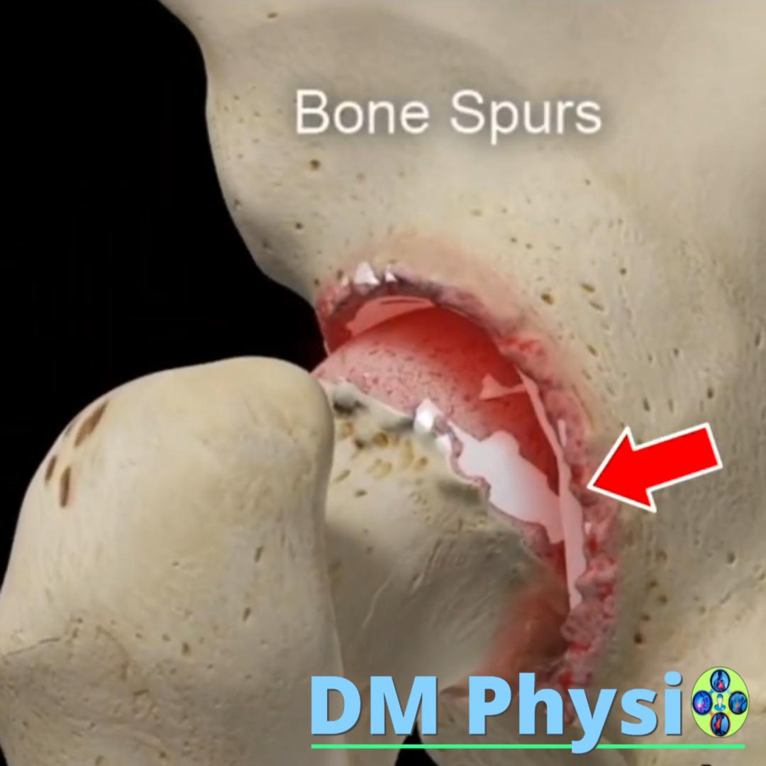 Коксартроза — артрит на тазобедрена става