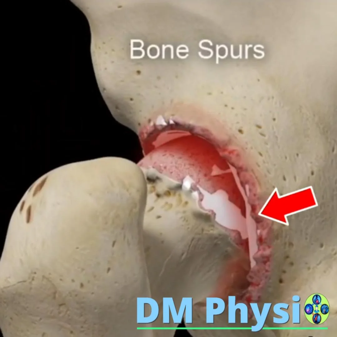 Коксартроза - визуализация