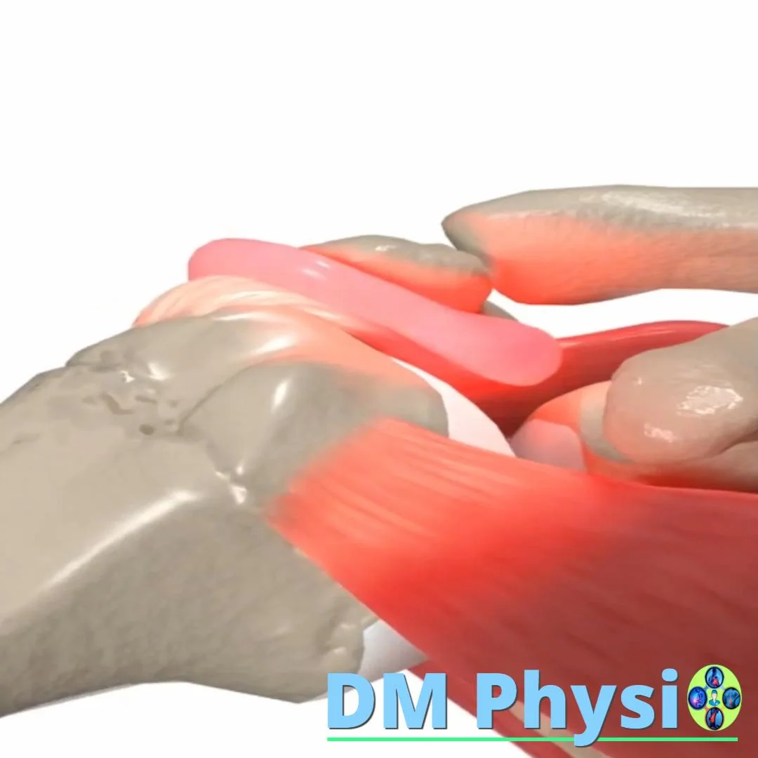 Импинджмънт синдром – прищипване в рамото