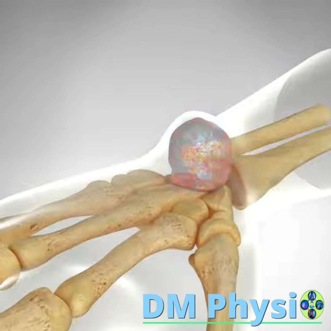 Дорзален ганглион на китката