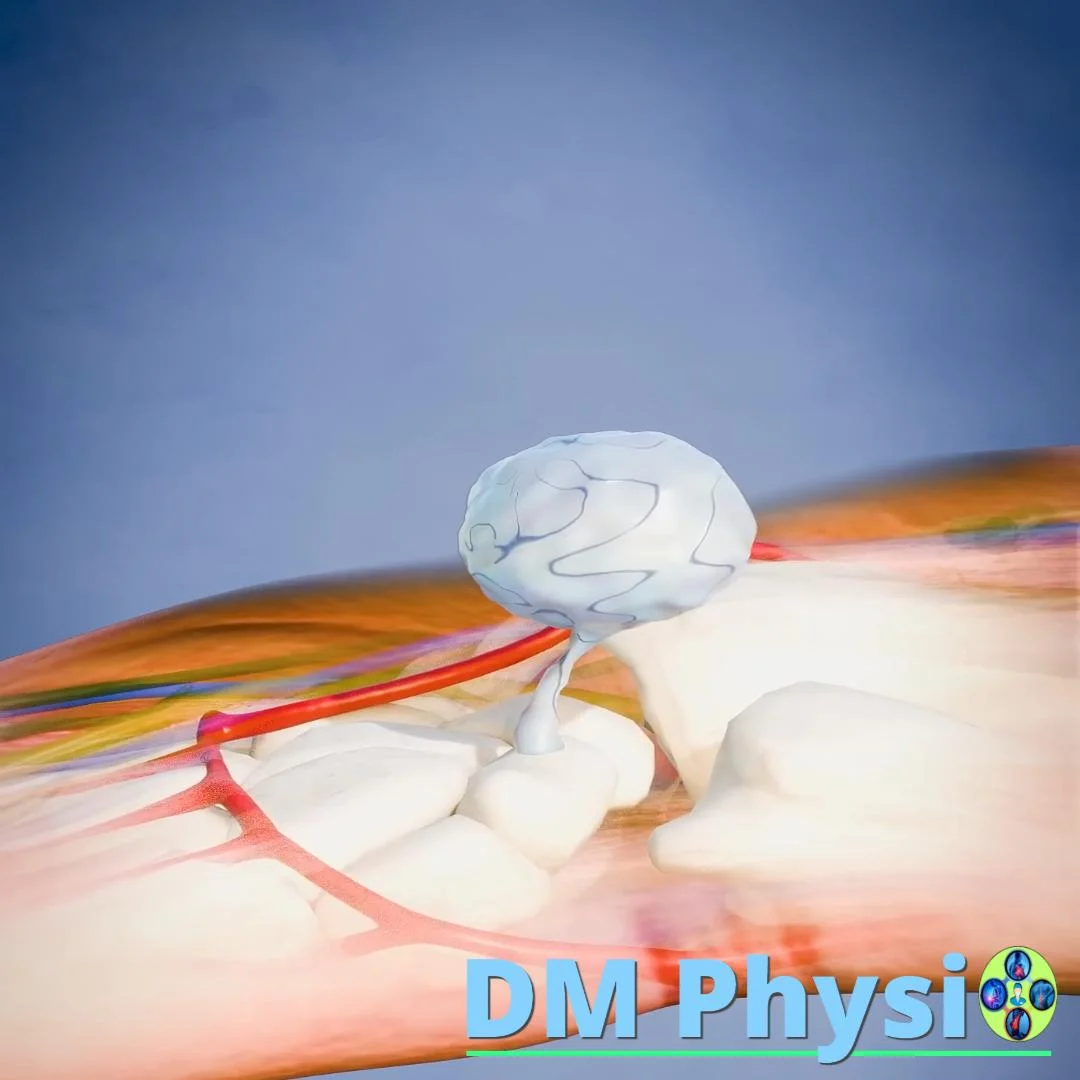 Воларен ганглион на китката