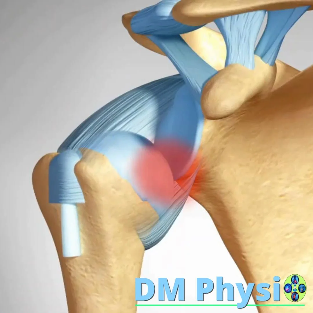 Луксация на раменна става (изкълчване)