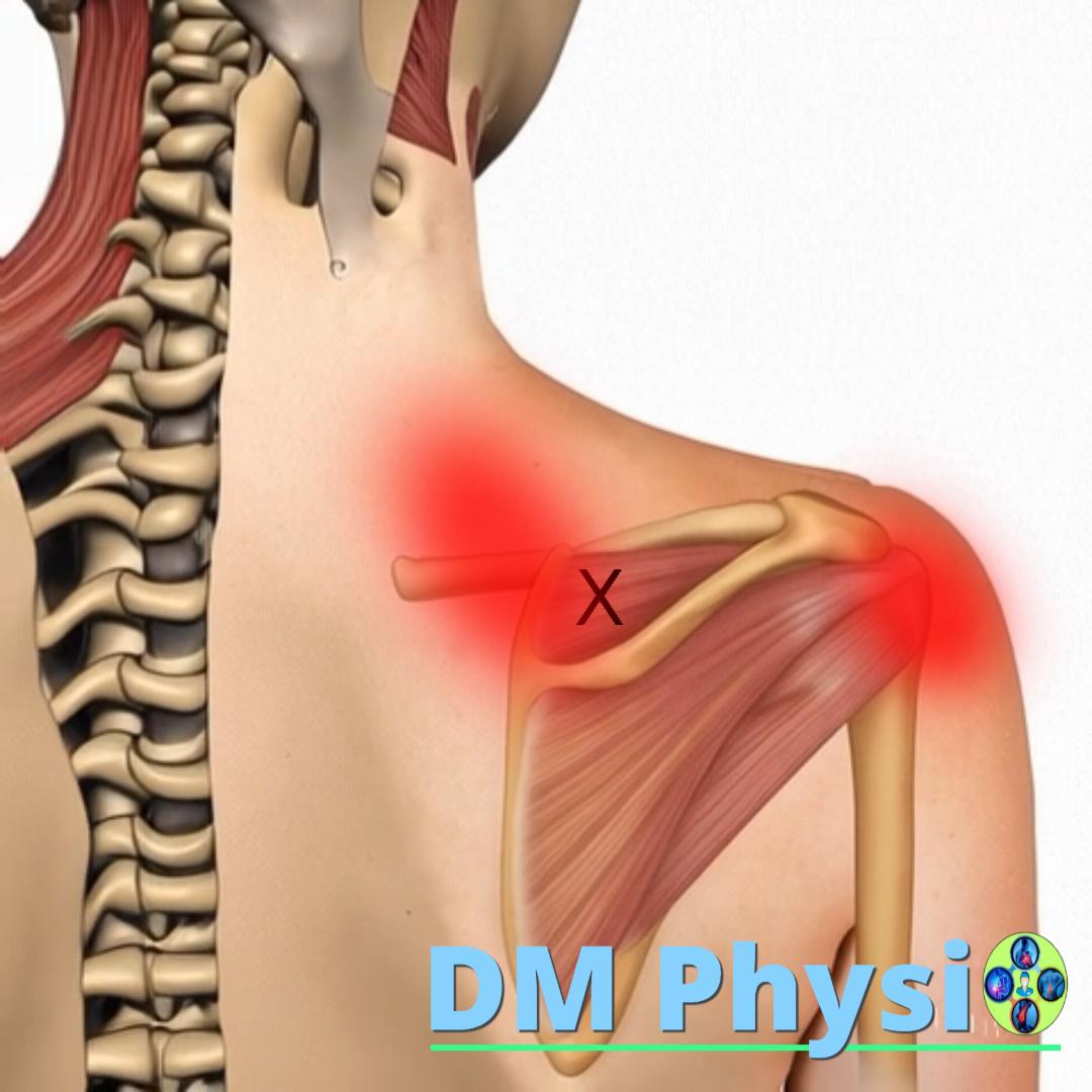 Изображение на мускула supraspinatus