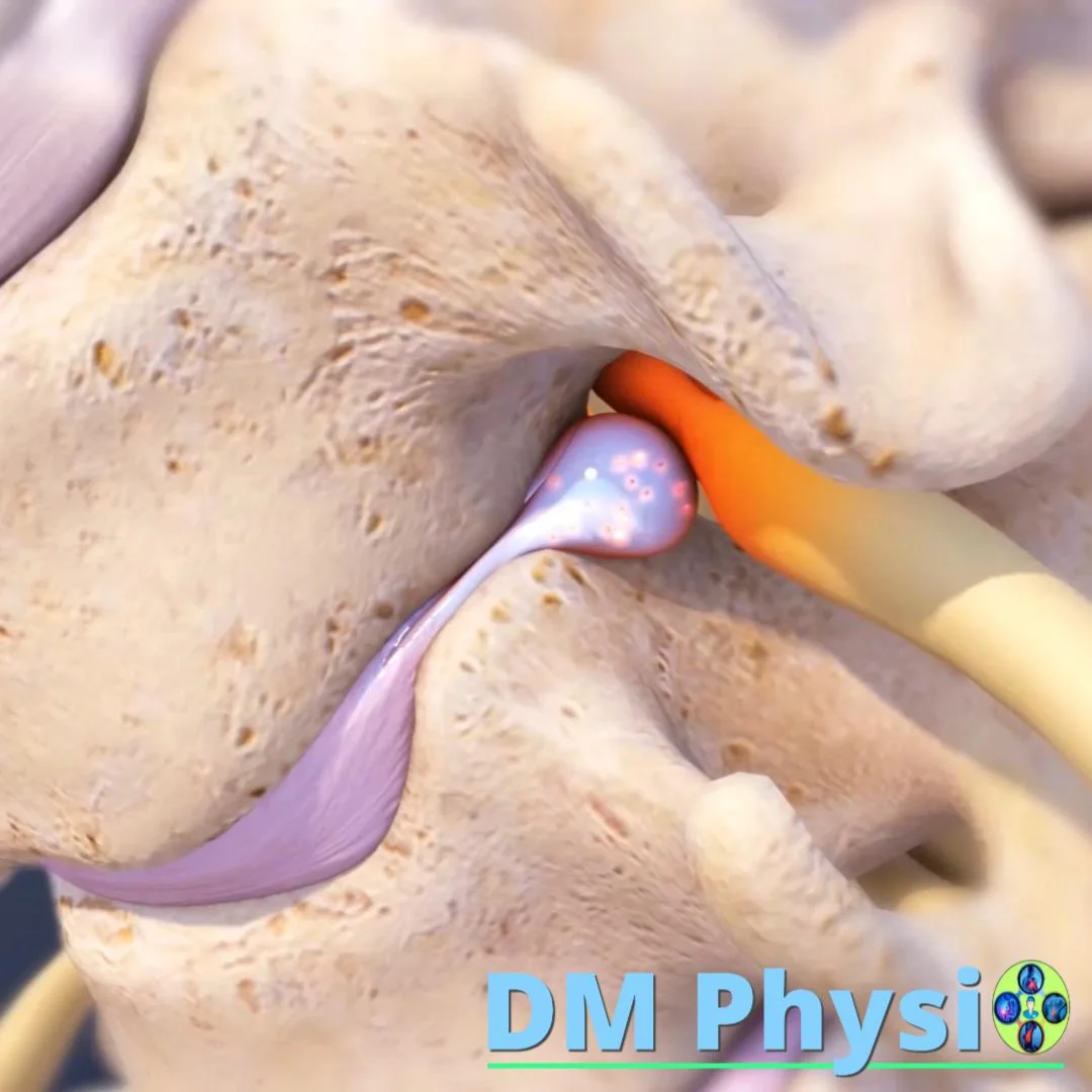 Нервна компресия при дискова херния