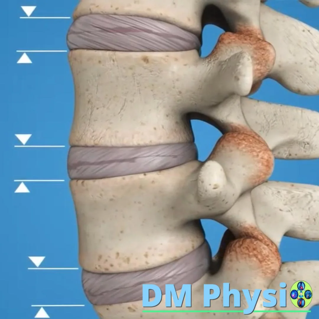 Шийна дегенерация на дискове