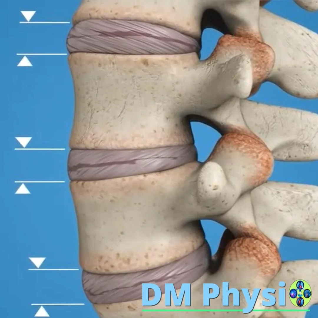 Изображение на дегенерация на дискове