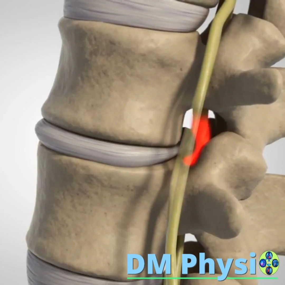 Визуализация на дегенерация на дискове