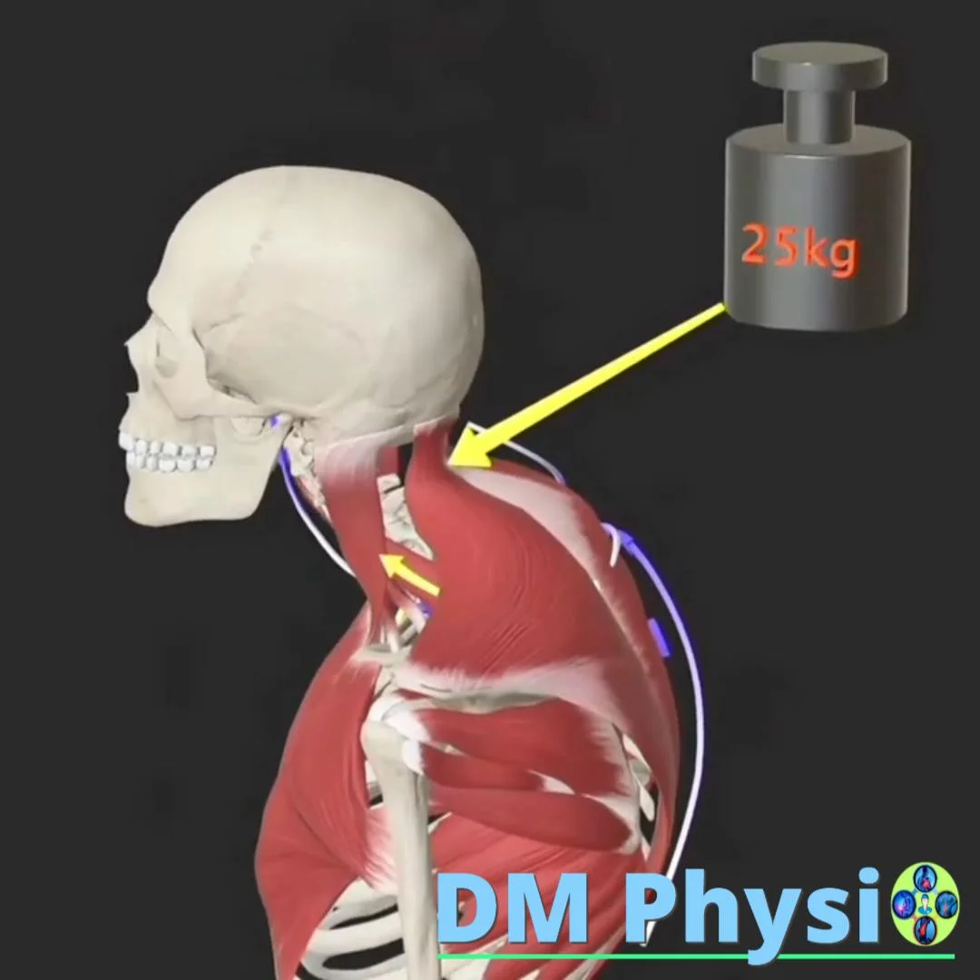 Горен кръстосан синдром