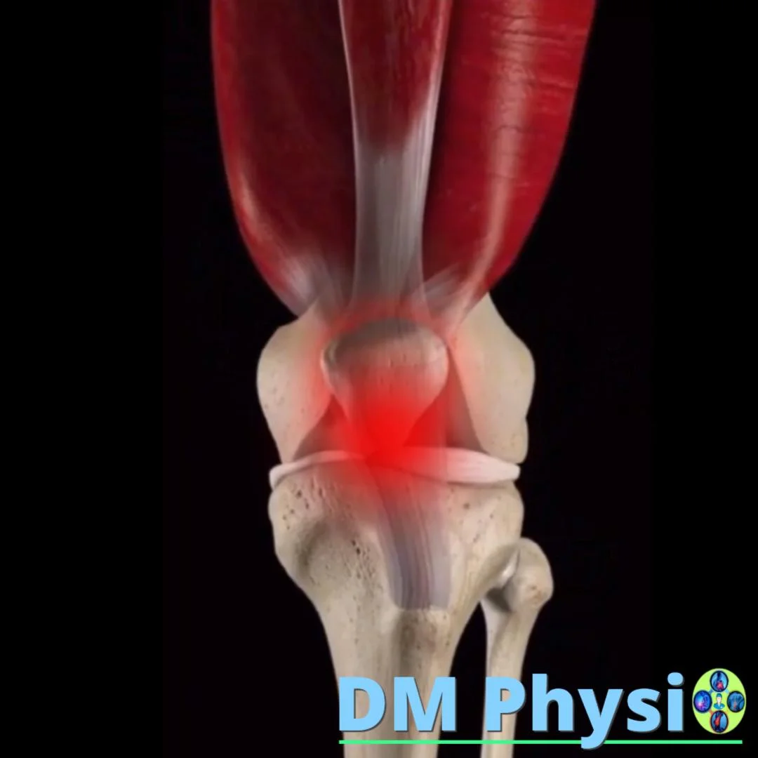 Пателофеморален болков синдром (PFPS)