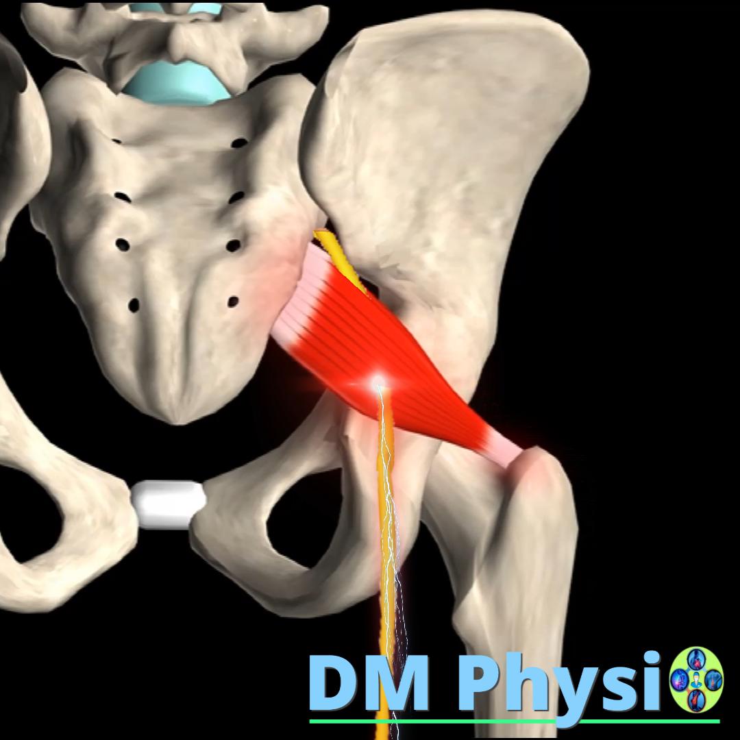 Пириформис синдром (седалищна болка)