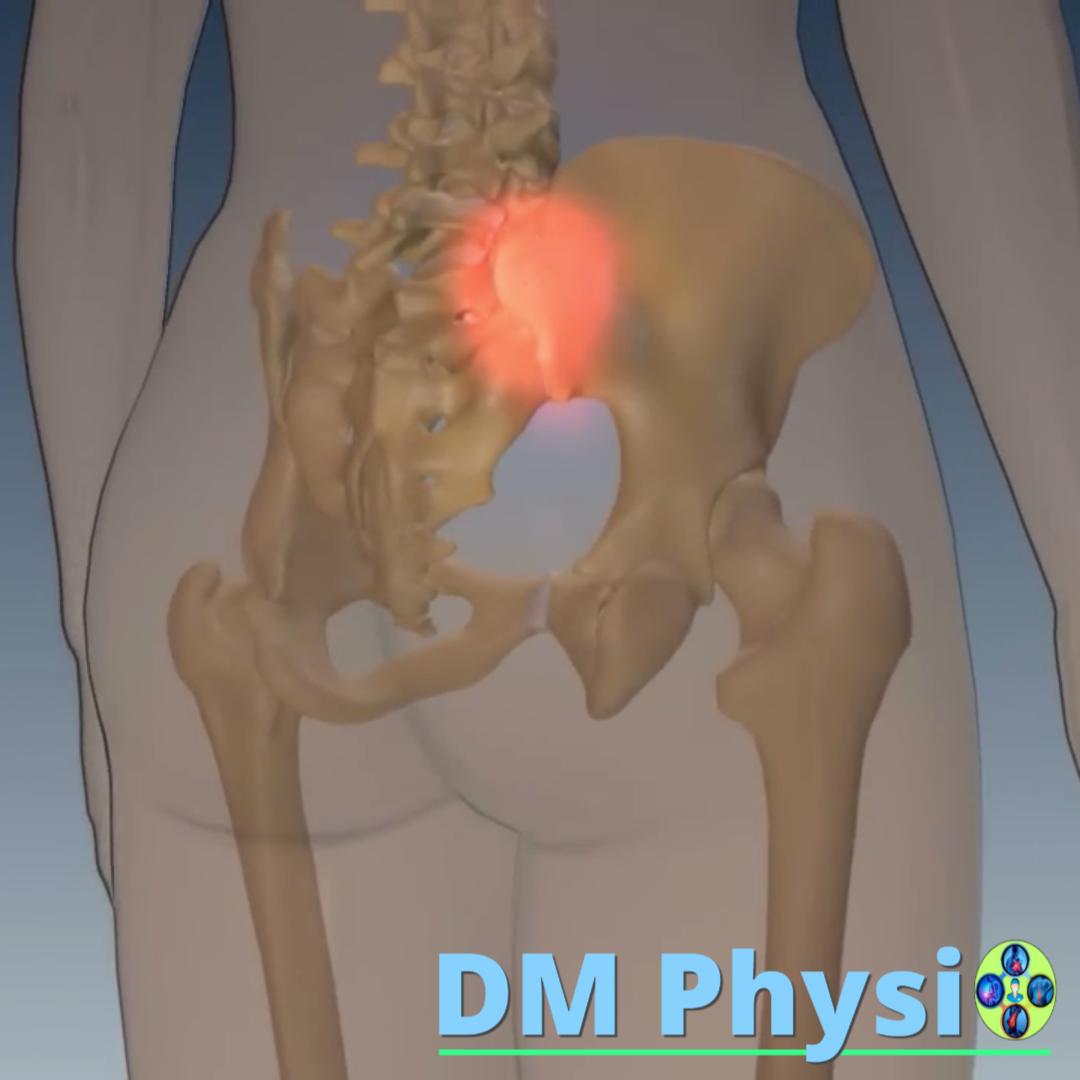 Сакроилиачен синдром (SI болка)