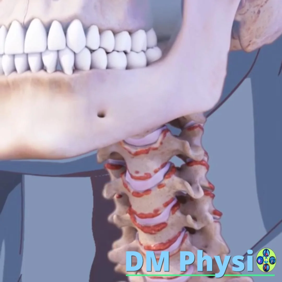 Шипове на врата (остеофити)
