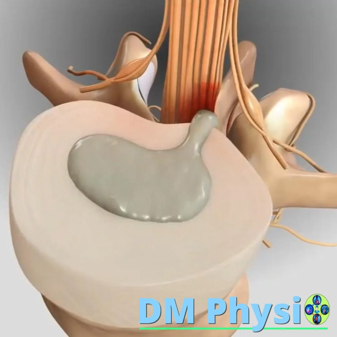 Изображение на дискова херния на врата